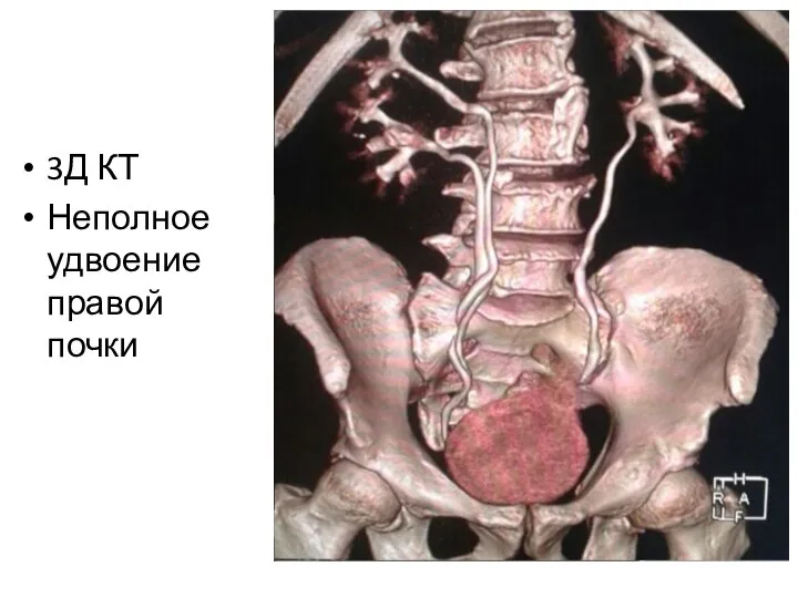 3Д КТ Неполное удвоение правой почки