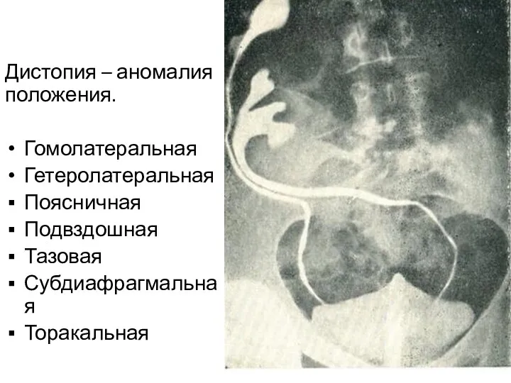 Дистопия – аномалия положения. Гомолатеральная Гетеролатеральная Поясничная Подвздошная Тазовая Субдиафрагмальная Торакальная