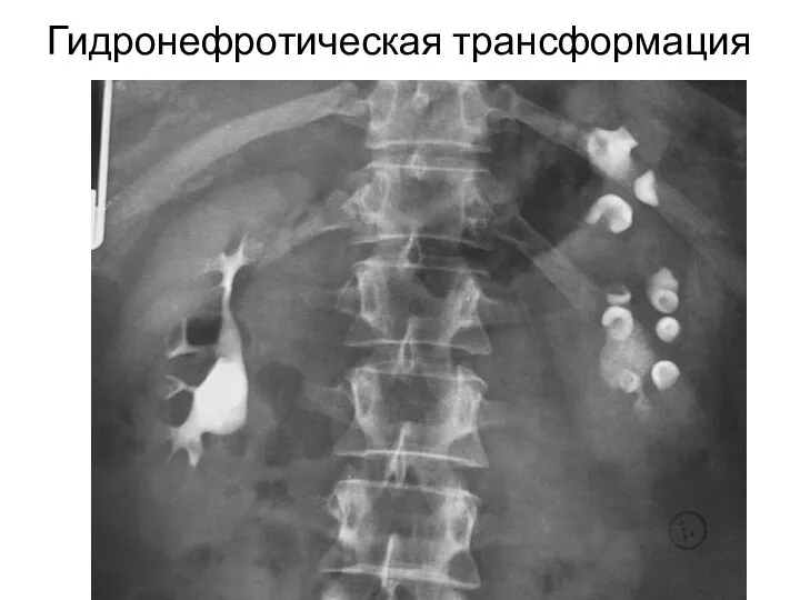 Гидронефротическая трансформация