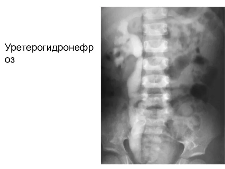 Уретерогидронефроз