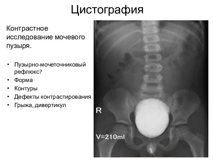 Цистография Контрастное исследование мочевого пузыря. Пузырно-мочеточниковый рефлюкс? Форма Контуры Дефекты контрастирования Грыжа, дивертикул