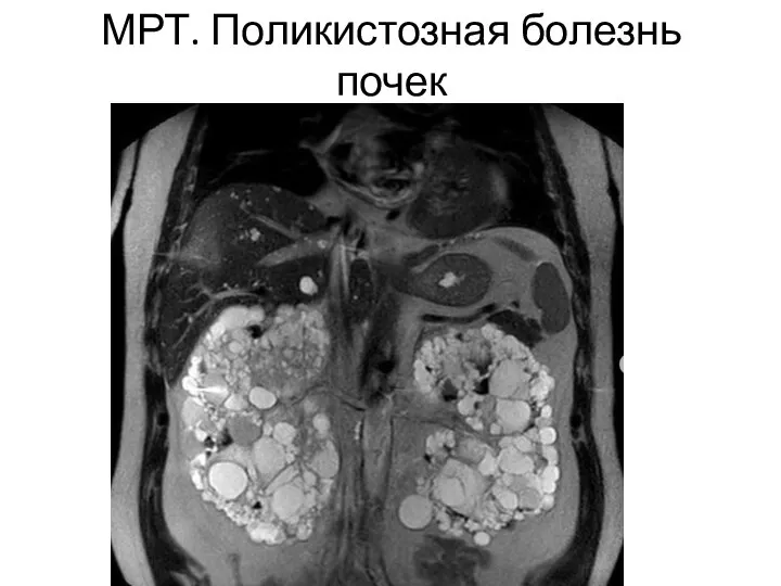 МРТ. Поликистозная болезнь почек