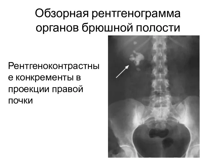 Обзорная рентгенограмма органов брюшной полости Рентгеноконтрастные конкременты в проекции правой почки