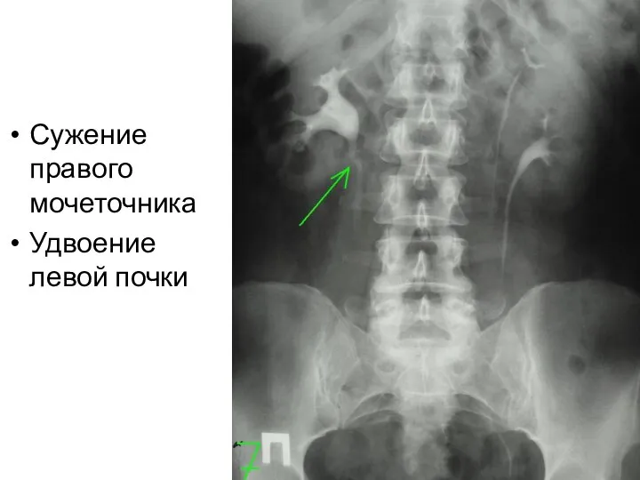 Сужение правого мочеточника Удвоение левой почки