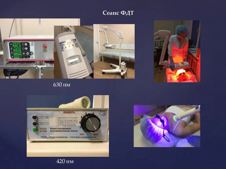 Сеанс ФДТ 630 нм 420 нм
