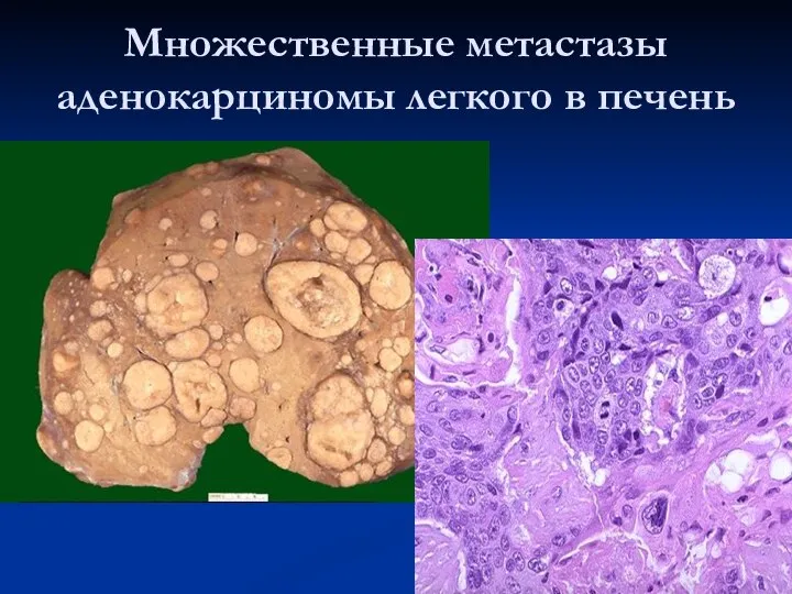 Множественные метастазы аденокарциномы легкого в печень