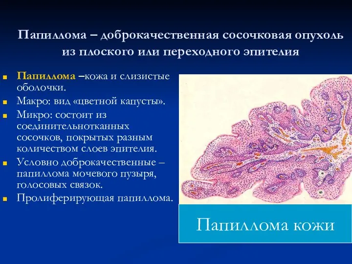 Папиллома – доброкачественная сосочковая опухоль из плоского или переходного эпителия Папиллома –кожа