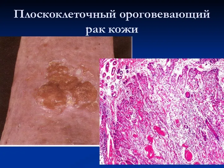 Плоскоклеточный ороговевающий рак кожи