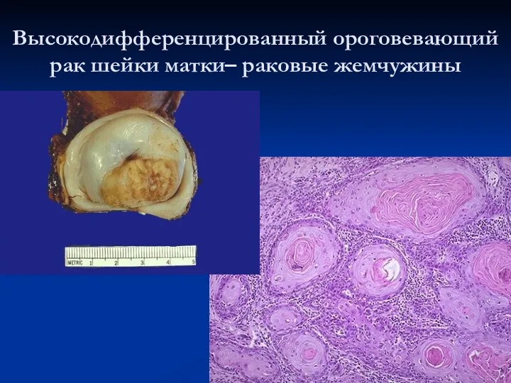 Высокодифференцированный ороговевающий рак шейки матки– раковые жемчужины