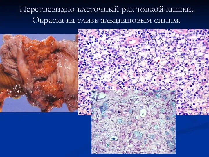 Перстневидно-клеточный рак тонкой кишки. Окраска на слизь альциановым синим.