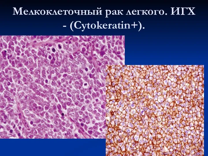 Мелкоклеточный рак легкого. ИГХ - (Cytokeratin+).
