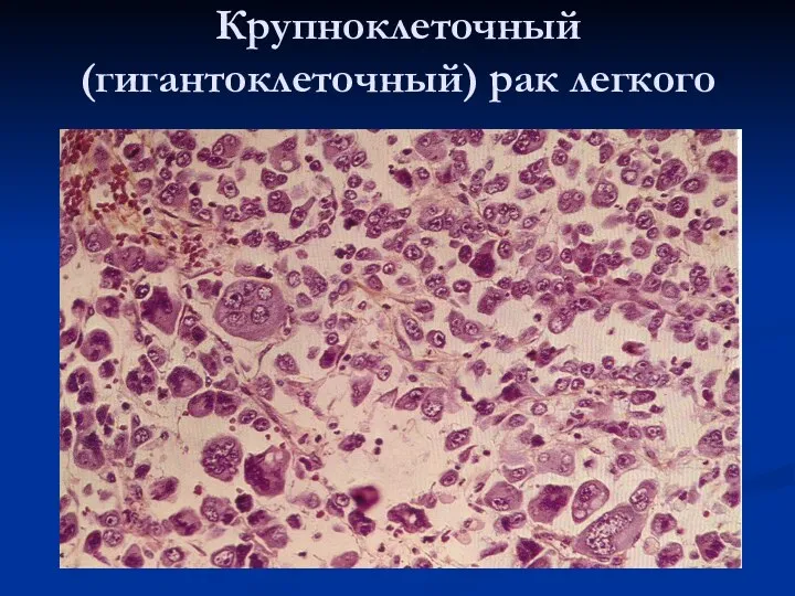 Крупноклеточный (гигантоклеточный) рак легкого