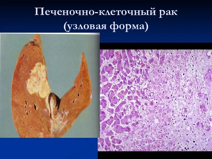 Печеночно-клеточный рак (узловая форма)