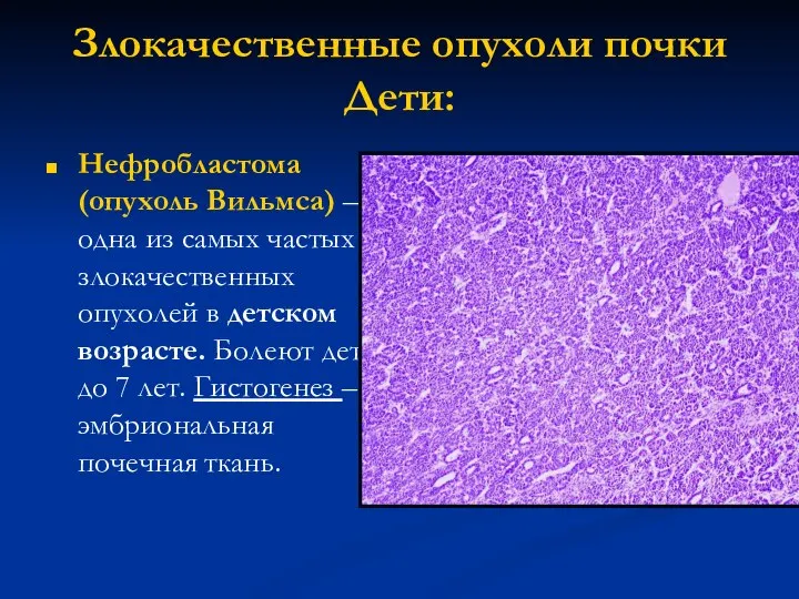 Злокачественные опухоли почки Дети: Нефробластома (опухоль Вильмса) – одна из самых частых