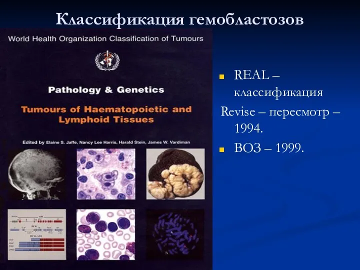Классификация гемобластозов REAL –классификация Revise – пересмотр – 1994. ВОЗ – 1999.