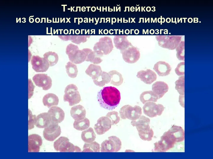 Т-клеточный лейкоз из больших гранулярных лимфоцитов. Цитология костного мозга.