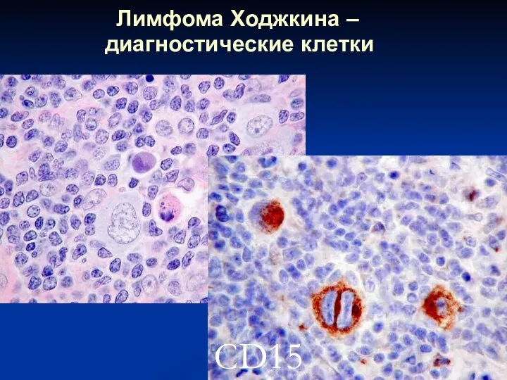Лимфома Ходжкина – диагностические клетки CD15