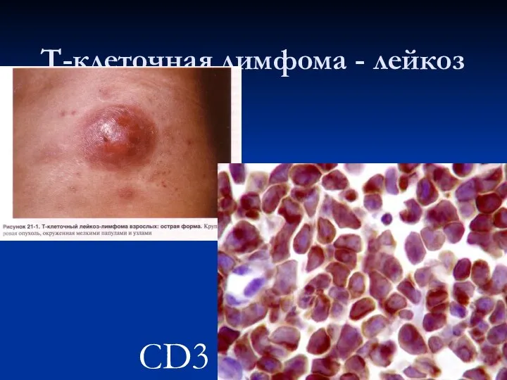 Т-клеточная лимфома - лейкоз CD3