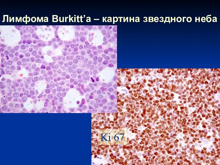 Лимфома Burkitt’а – картина звездного неба Ki 67