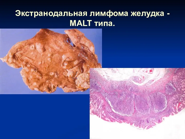 Экстранодальная лимфома желудка - MALT типа.