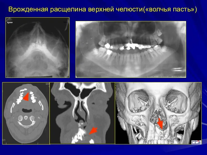 Врожденная расщелина верхней челюсти(«волчья пасть»)