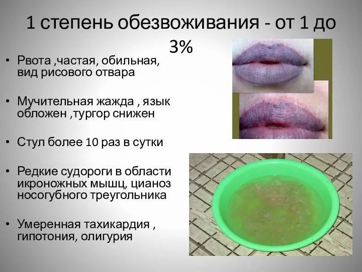 1 степень обезвоживания - от 1 до 3% Рвота ,частая, обильная, вид