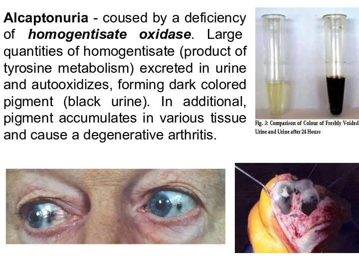 Alcaptonuria - coused by a deficiency of homogentisate oxidase. Large quantities of