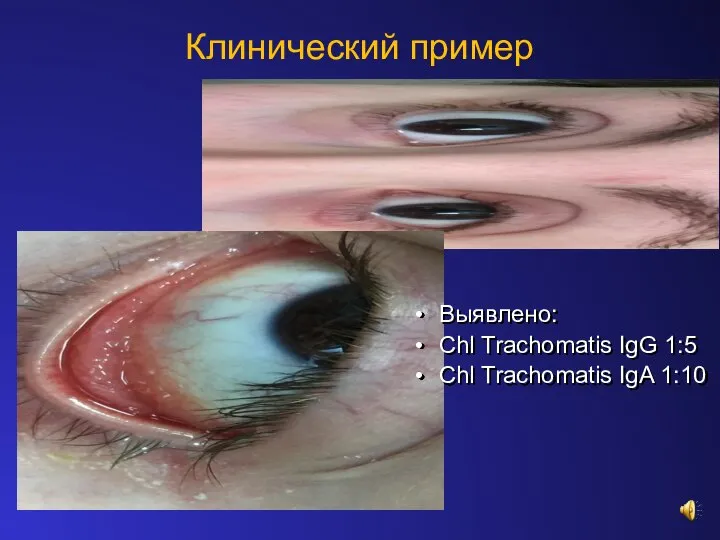 Клинический пример Выявлено: Chl Trachomatis IgG 1:5 Chl Trachomatis IgA 1:10