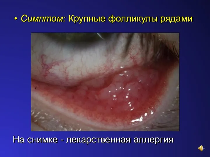 Симптом: Крупные фолликулы рядами На снимке - лекарственная аллергия
