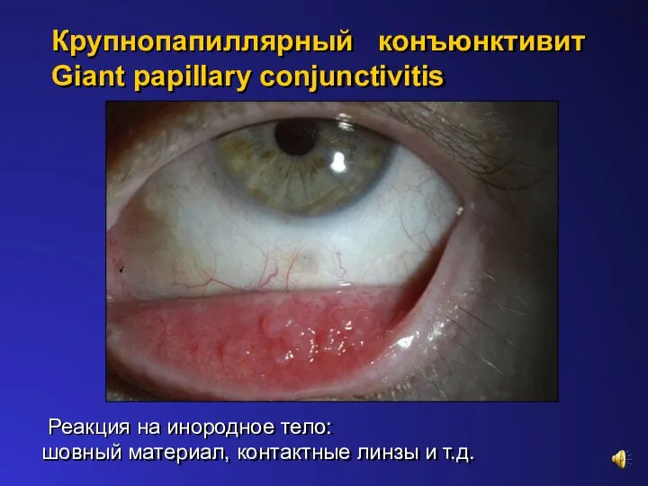 Крупнопапиллярный конъюнктивит Giant papillary conjunctivitis Реакция на инородное тело: шовный материал, контактные линзы и т.д.