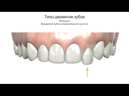 Типы движения зубов Интрузия Внедрение зуба в альвеолярный отросток