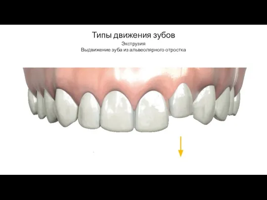 Типы движения зубов Экструзия Выдвижение зуба из альвеолярного отростка
