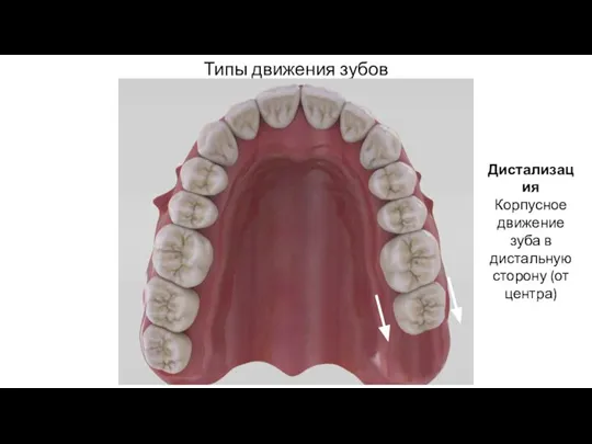 Типы движения зубов Дистализация Корпусное движение зуба в дистальную сторону (от центра)
