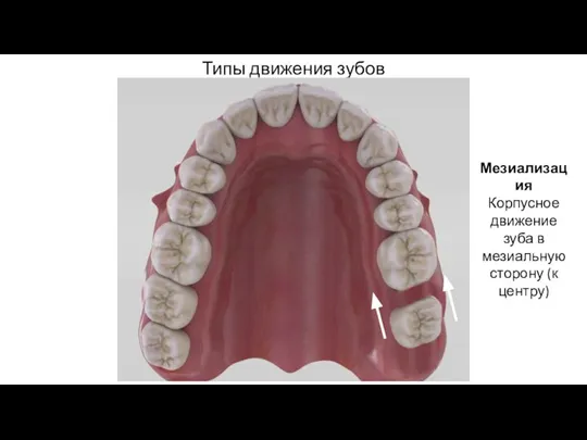 Типы движения зубов Мезиализация Корпусное движение зуба в мезиальную сторону (к центру)