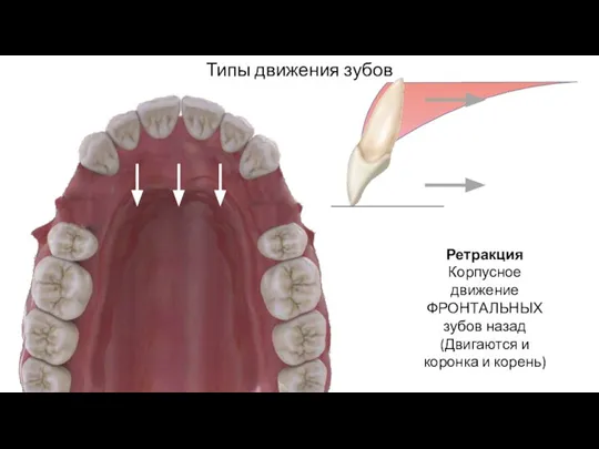 Типы движения зубов Ретракция Корпусное движение ФРОНТАЛЬНЫХ зубов назад (Двигаются и коронка и корень)