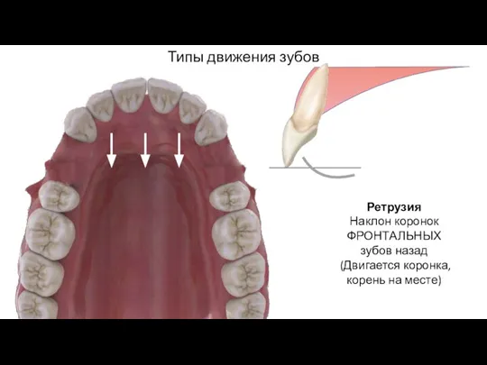 Типы движения зубов Ретрузия Наклон коронок ФРОНТАЛЬНЫХ зубов назад (Двигается коронка, корень на месте)
