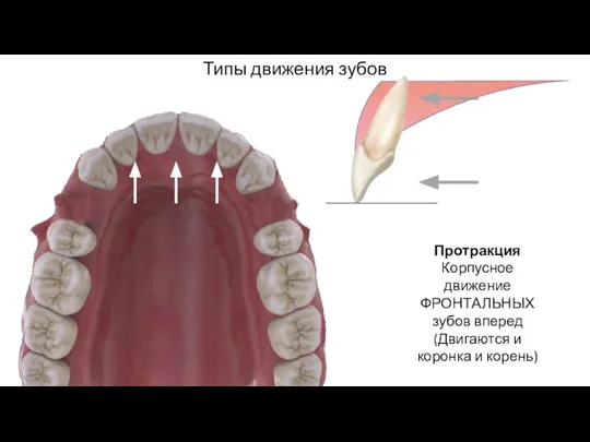 Типы движения зубов Протракция Корпусное движение ФРОНТАЛЬНЫХ зубов вперед (Двигаются и коронка и корень)