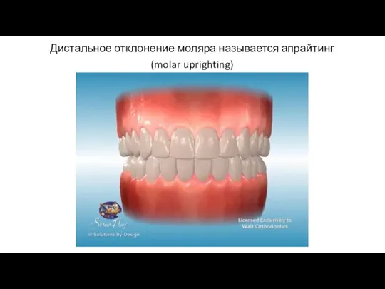 Дистальное отклонение моляра называется апрайтинг (molar uprighting)