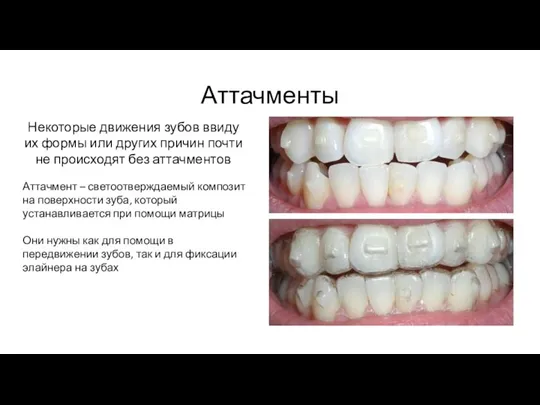 Аттачменты Некоторые движения зубов ввиду их формы или других причин почти не