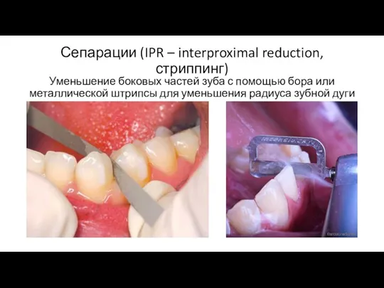 Сепарации (IPR – interproximal reduction, стриппинг) Уменьшение боковых частей зуба с помощью