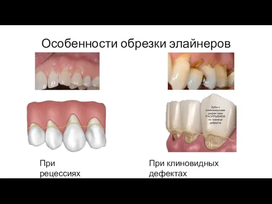 Биомеханика передвижения зубов Особенности обрезки элайнеров При рецессиях При клиновидных дефектах
