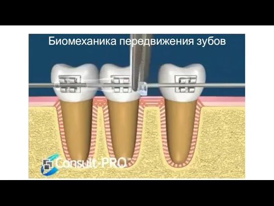 Биомеханика передвижения зубов