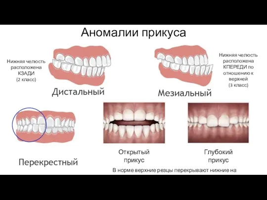 Аномалии прикуса Нижняя челюсть расположена КЗАДИ (2 класс) Нижняя челюсть расположена КПЕРЕДИ