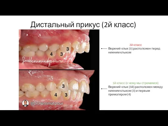 Дистальный прикус (2й класс) 2й класс Верхний клык (3) расположен перед нижним