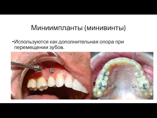 Миниимпланты (минивинты) Используются как дополнительная опора при перемещении зубов.