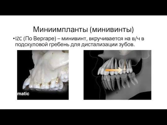 Миниимпланты (минивинты) IZC (По Вергаре) – минивинт, вкручивается на в/ч в подскуловой гребень для дистализации зубов.