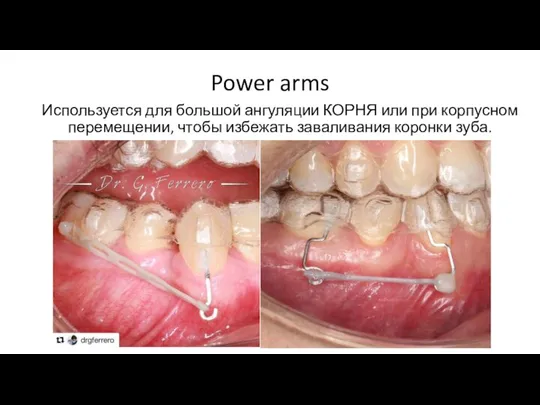 Power arms Используется для большой ангуляции КОРНЯ или при корпусном перемещении, чтобы избежать заваливания коронки зуба.