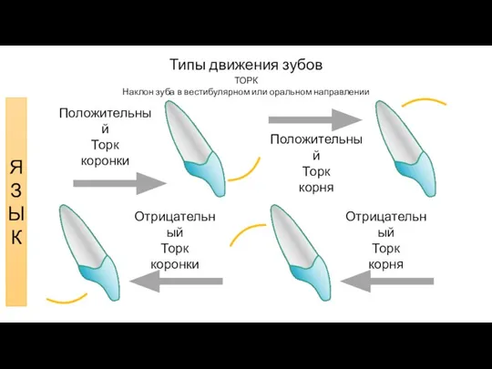 Типы движения зубов ТОРК Наклон зуба в вестибулярном или оральном направлении Положительный