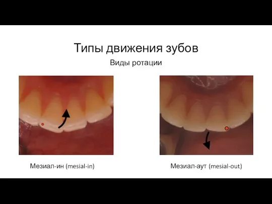 Типы движения зубов Виды ротации Мезиал-ин (mesial-in) Мезиал-аут (mesial-out)