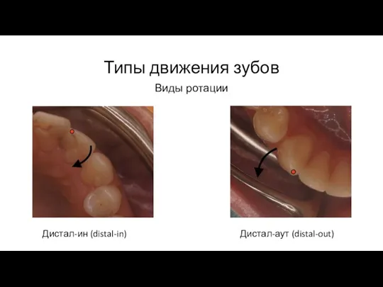 Типы движения зубов Виды ротации Дистал-ин (distal-in) Дистал-аут (distal-out)